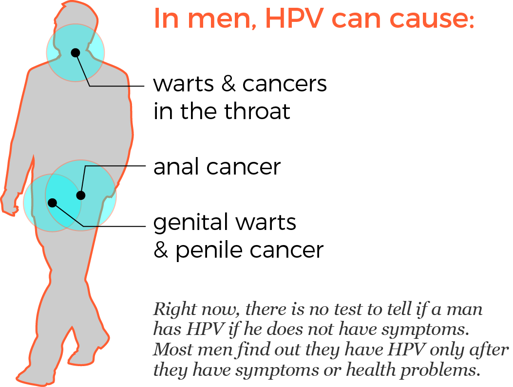 In men, HPV can cause: warts and cancers in the throat, anal cancer, genital warts and penile cancer. Right now, there is no test available to tell if a man has HPV if he doesn’t have symptoms. Most men find out they have HPV only after they have symptoms or health problems